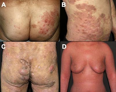 Mycosis fungoides and Sézary syndrome: clinical presentation, diagnosis, staging, and therapeutic management